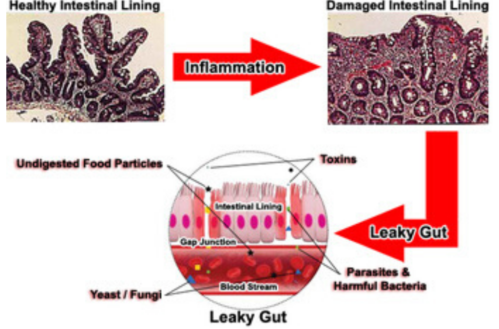 Altered Immunity and Leaky Gut Syndrome