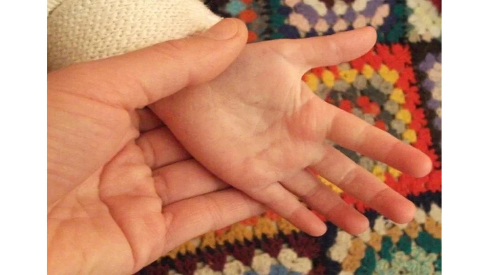 Yummy Doctor Holistic Health Education - Blog - Homeopathic Remedies for Burns Yummy Doctor Holistic Health Education - Blog - Homeopathic Remedies for Burns